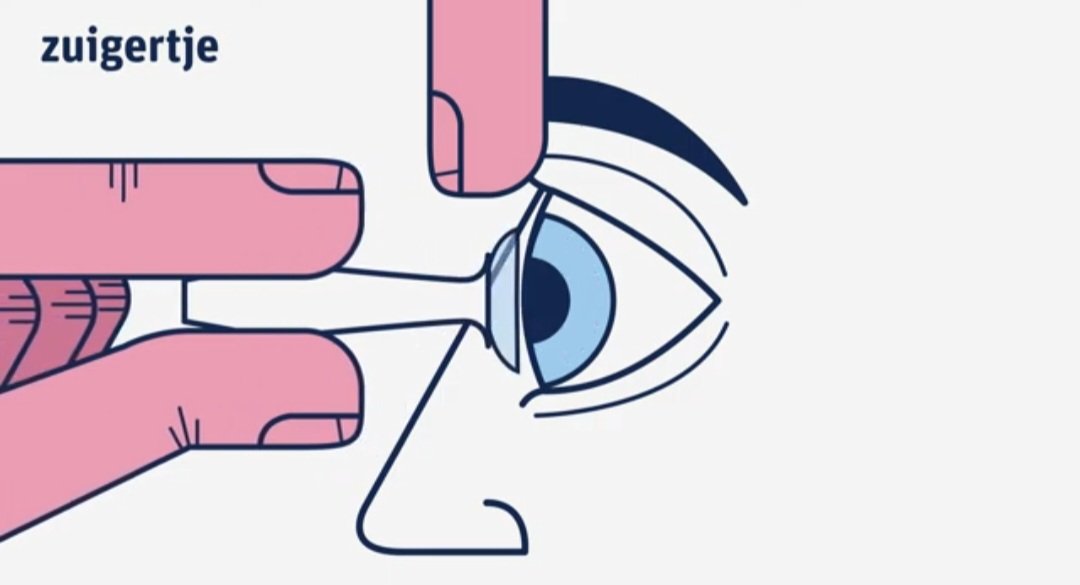 ZONN opticiens harde contactlenzen uithalen