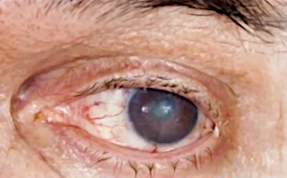 Staar oog ZONN opticiens